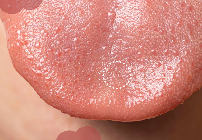 Tongue Bumps: Common Causes and Effective Treatments