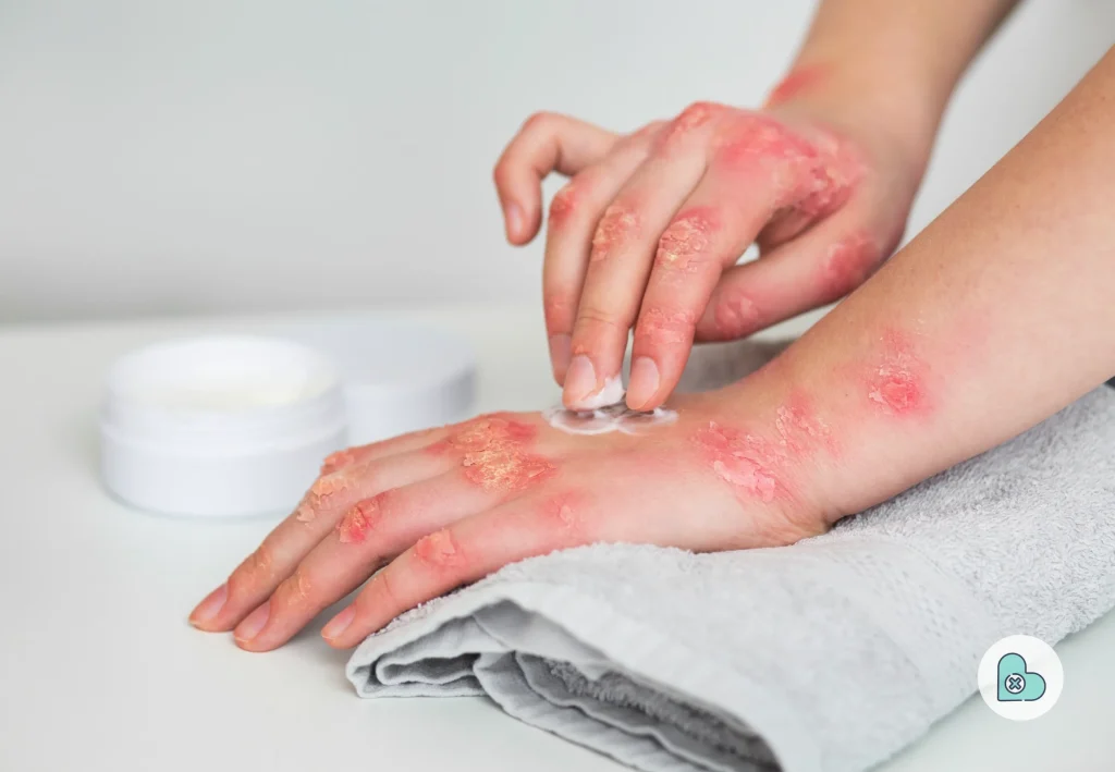 Home Remedies for Rash