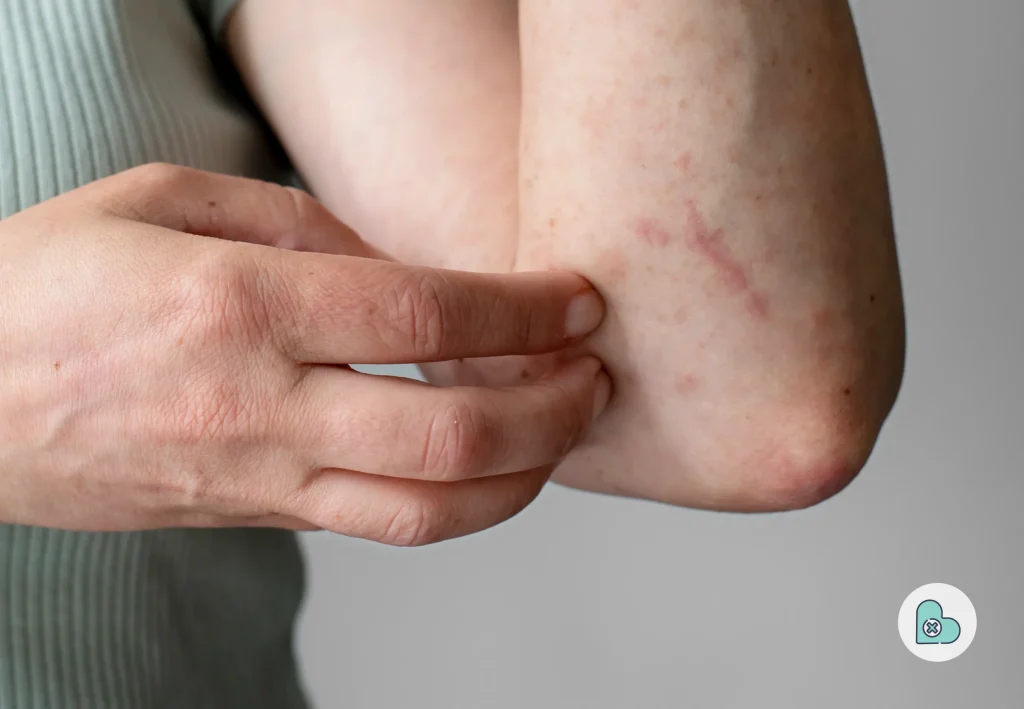 Types of rashes, their symptoms, and how they appear on different skin tones.